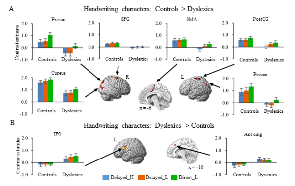 研究揭示漢語閱讀障礙兒童書寫與閱讀的腦功能異常