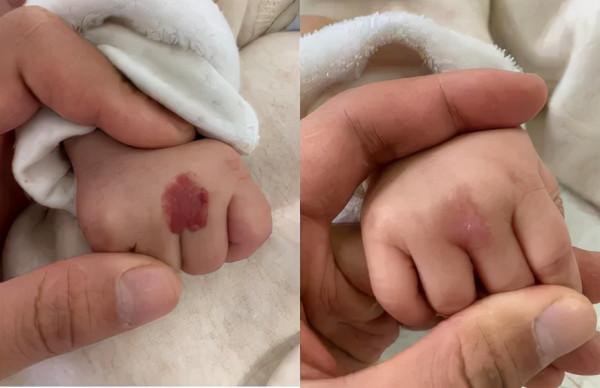 莫把血管瘤當胎記,嬰幼兒治療要趁早 莫把血管瘤當胎記,嬰幼兒治療要趁早