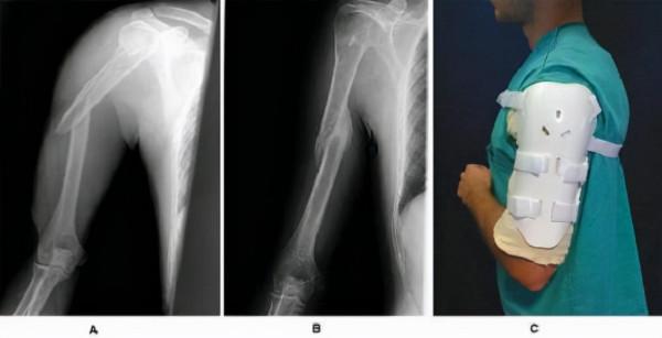 肱骨幹骨折術後康復方案