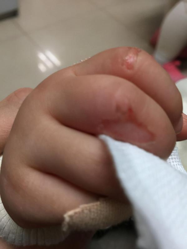 故事:韓國5歲男孩患異食癖,沉迷生肉無法自拔,2年吃掉730斤豬肝