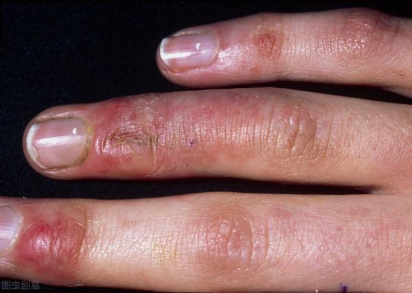 冬天手總愛凍,有什麼好辦法可以預防嗎 冬天手總愛凍,有什麼好辦法可以預防嗎