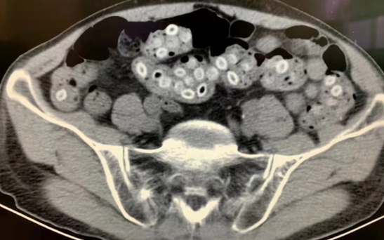 吃棗吃進ICU？這些食物要小心了