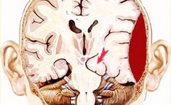 「科普」外傷跌倒摔傷頭部，要是有過昏迷，時間再短也要警惕