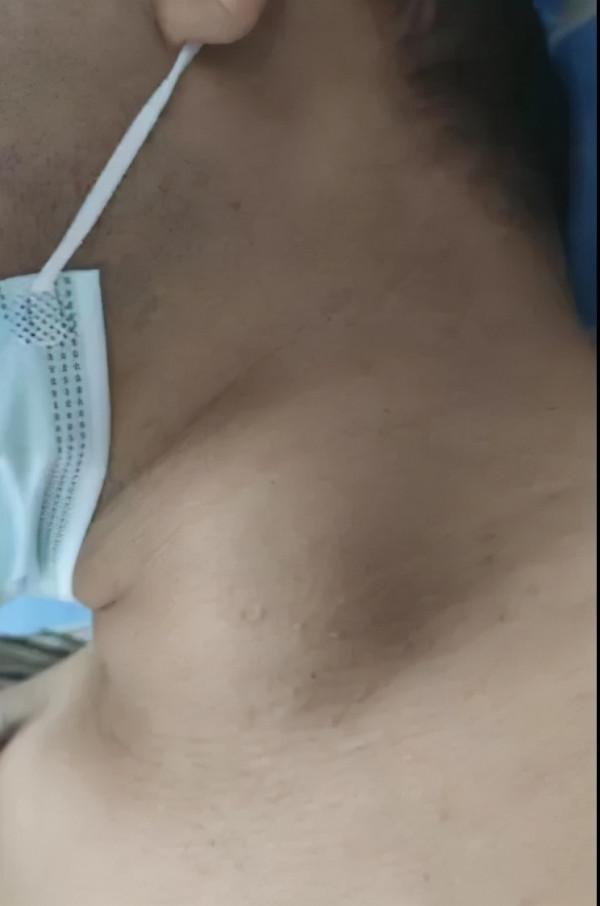 年輕小夥“甩頭”過猛，脖子鼓起一個“包”，血管差點破裂