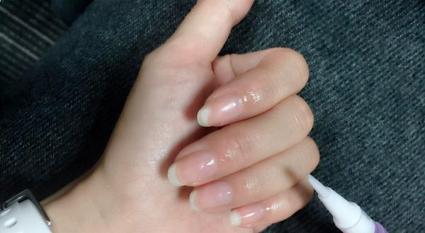 手上長不完的倒刺,真的是缺維生素嗎?教你3招,輕鬆去除倒刺 手上長不完的倒刺,真的是缺維生素嗎?教你3招,輕鬆去除倒刺