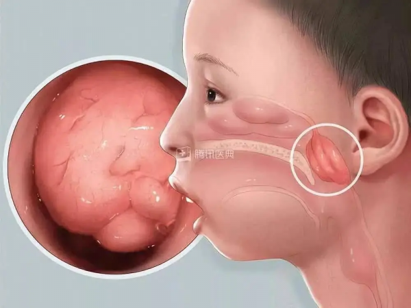 張口呼吸會長歪,用“閉嘴貼”?醫生:胡來! 張口呼吸會長歪,用“閉嘴貼”?醫生:胡來!