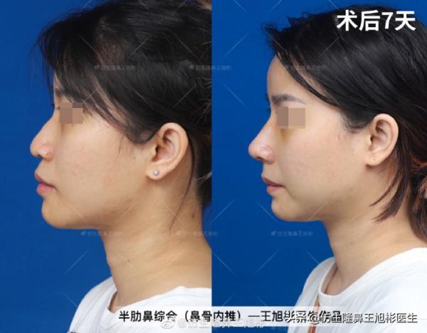 鼻基底填充後,為什麼會變成“猴子”?原來是裡沒有處理好 鼻基底填充後,為什麼會變成“猴子”?原來是裡沒有處理好