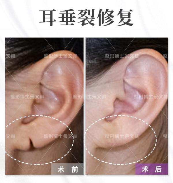 耳垂畸形修復手術後，會出現嚴重的併發症嗎？