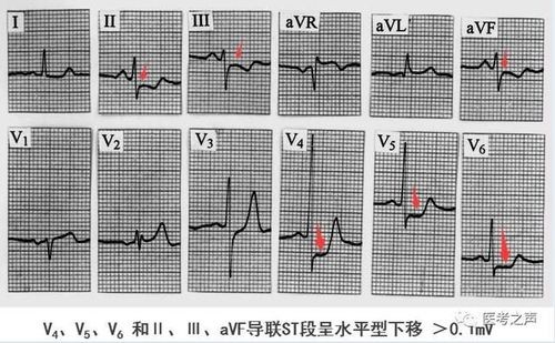 兩種中成藥，多靶點“清理血液”，從根上疏通冠脈，改善心肌缺血