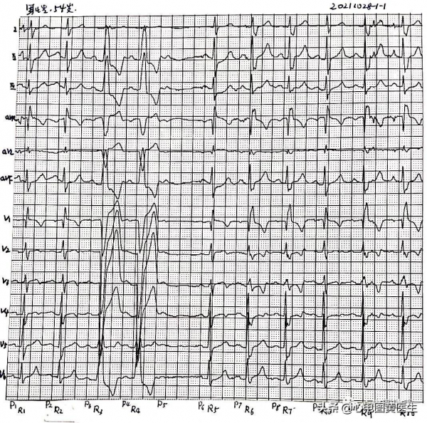 心電圖病例討論:中老年男性,發作性心悸入院,有冠心病史 心電圖病例討論:中老年男性,發作性心悸入院,有冠心病史