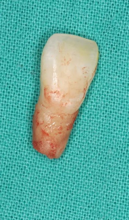 同仁醫線丨精準種植，美學修復，再也不用愁眉苦臉了