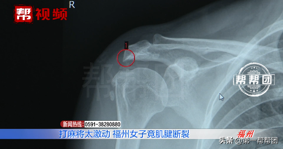 打麻將打到肌腱斷裂？麻將：這個鍋不背