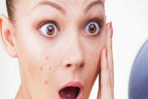 痘痘反覆不見好?可能是2件事沒做好,想要祛痘,3個習慣很重要 痘痘反覆不見好?可能是2件事沒做好,想要祛痘,3個習慣很重要