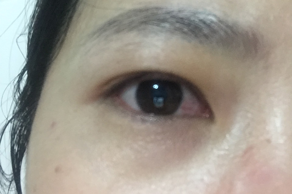 第一批用鐳射手術治近視的人，現在眼睛怎麼樣了？有後遺症嗎？