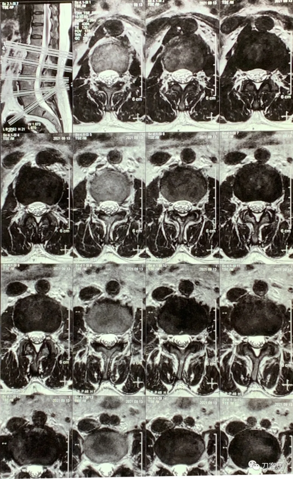 查體的重要性，一直按照腰椎間盤突出症治療的脊髓型頸椎病