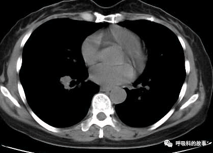 咳嗽半年反覆肺炎為什麼治不好 細看影像發現端倪緣是異物堵塞