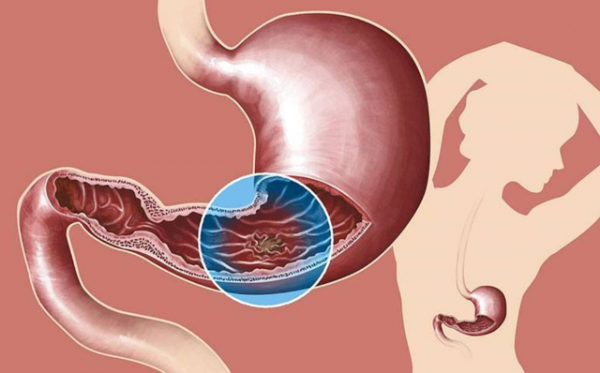 身體若發出這5個訊號，或要去做“直腸指檢”，別害羞