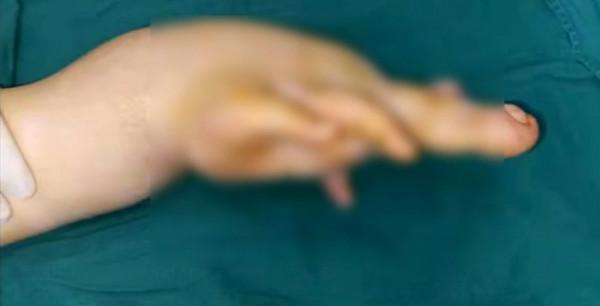 男孩手指頭比香蕉還粗,醫生都說沒見過 男孩手指頭比香蕉還粗,醫生都說沒見過