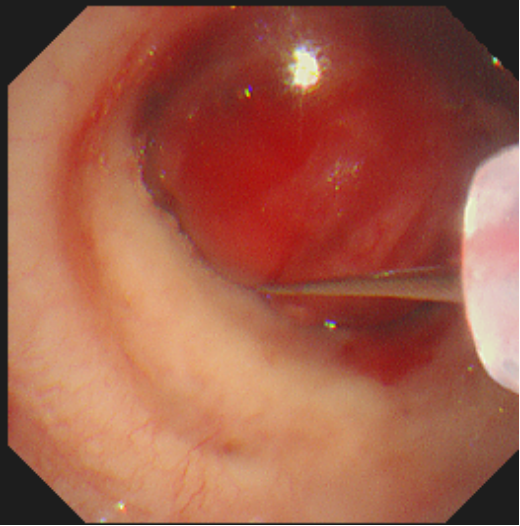 吸菸飲酒三四十年為腫瘤“鋪就溫床”，手指粗的肉瘤突然瘋長進男子支氣管