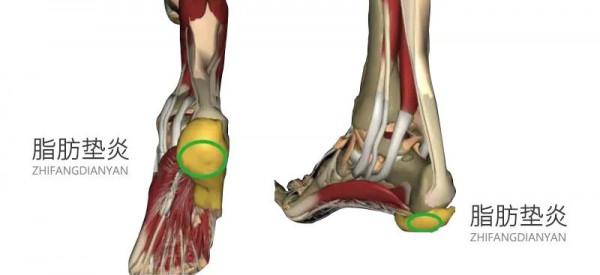 讓人飽受折磨的足跟痛是頑疾？試試這3個方法，輕鬆緩解疼痛