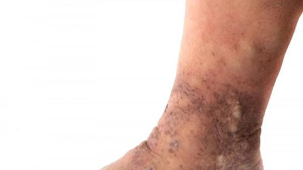 過敏和慢性面板病為啥少吃或不吃海鮮? 過敏和慢性面板病為啥少吃或不吃海鮮?