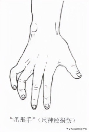 手麻！不可忽視的另一病因