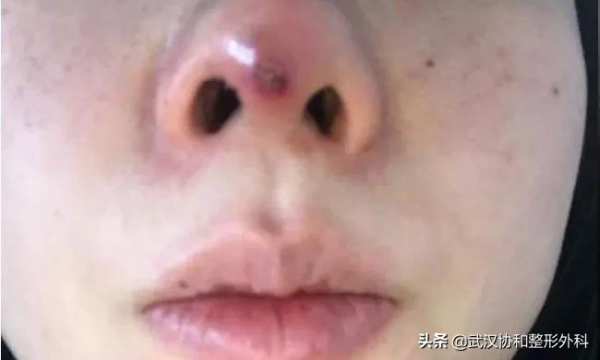 為什麼不建議做線雕隆鼻？