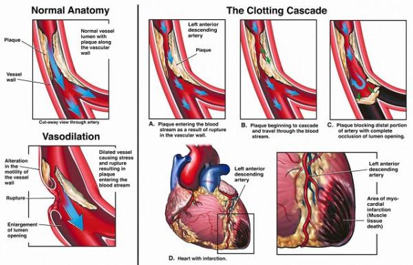 麝香保心丸,增加冠脈供血抗心絞痛,促進心肌血管再生,保護心臟 麝香保心丸,增加冠脈供血抗心絞痛,促進心肌血管再生,保護心臟