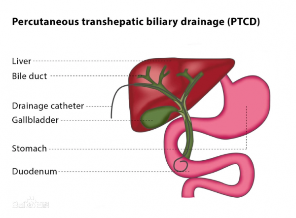 「膽道疾病患者的福音」經皮肝穿刺膽道引流術(PTCD）