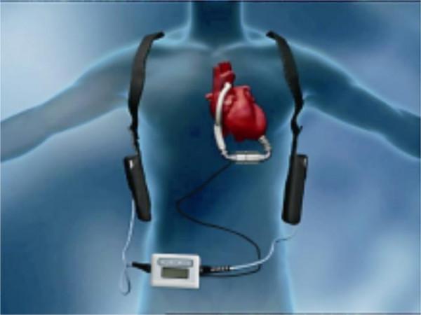 “二師兄”立功！美國將豬心移植給57歲病人，術後3天病情穩定