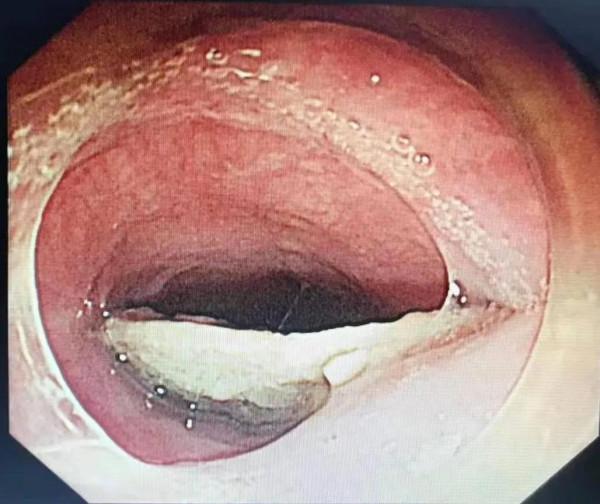 異物卡喉不少見，緊急處置需得當