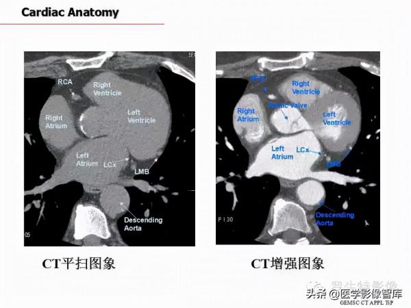 CT斷層解剖圖譜最全總結「推薦收藏」 CT斷層解剖圖譜最全總結「推薦收藏」