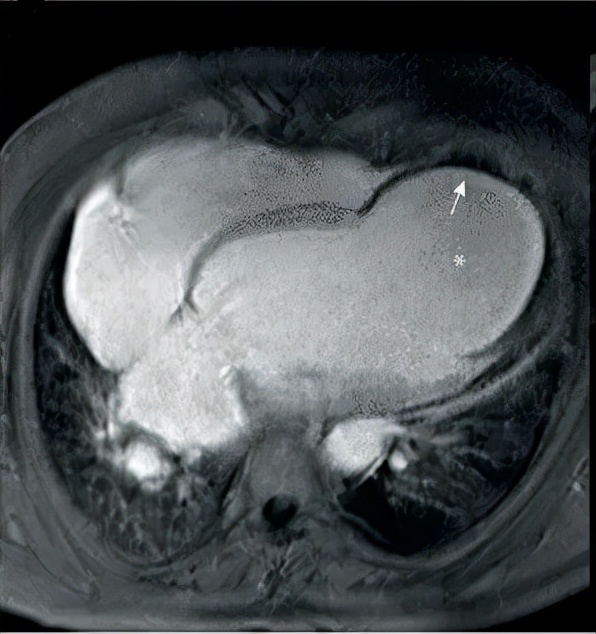 心臟上長出的“氣球”：心臟室壁瘤你瞭解嗎
