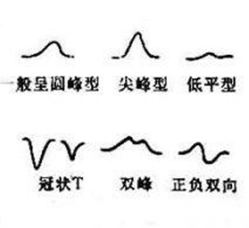 心電圖T波改變是怎麼回事兒?就是冠心病嗎? 心電圖T波改變是怎麼回事兒?就是冠心病嗎?