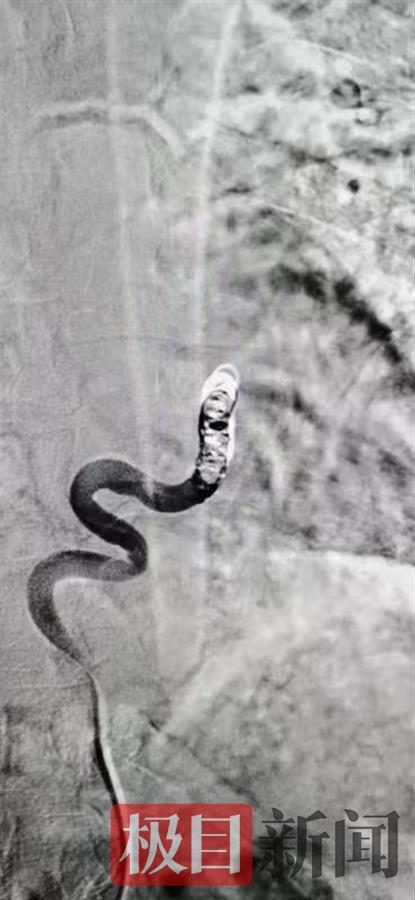 罕見！男子大口咯血，竟是腹部多長了一根血管，還悄悄連上了肺……