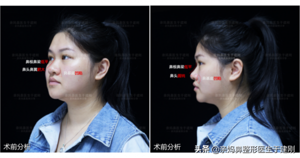 30歲姑娘，糾結10年不敢做鼻整形手術，如今卻突然來隆鼻變美