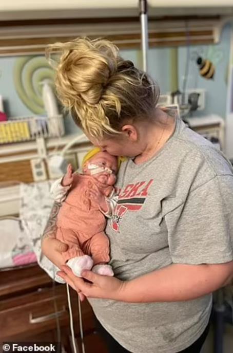 美國罕見雙子宮媽媽，一邊各懷一個娃，22周半早產只存活一個