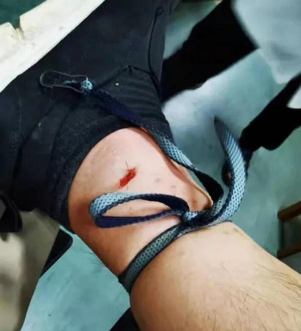 命大！浙江男子被五步蛇烙鐵頭咬傷，自救成功，它的毒性有多強？