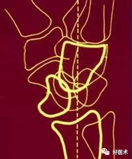 贊！腕關節X線高畫質解剖+腕骨脫位典型病例