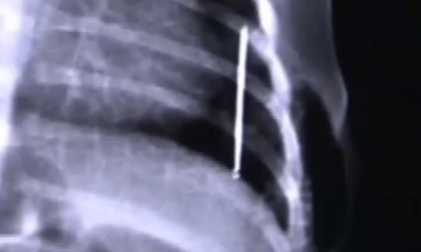 真實故事：陝西1歲幼童患怪病，身體長出鐵釘，醫生查明真相