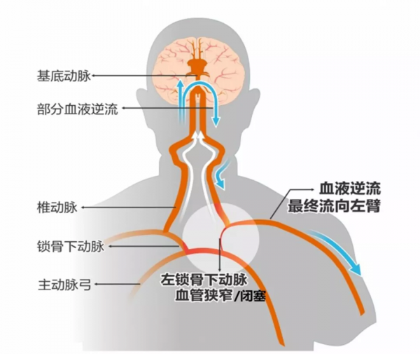 北京老年醫院成功完成經橈動脈入路慢性鎖骨下動脈閉塞再通術 北京老年醫院成功完成經橈動脈入路慢性鎖骨下動脈閉塞再通術