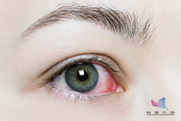 為啥有些人睡覺半睜眼？是因為眼睛太大？醫生：可能是這些病