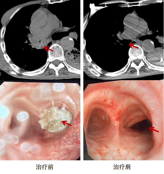 一陣劇烈嗆咳後，78歲劉老伯生命垂危！竟是一塊豬蹄惹的禍