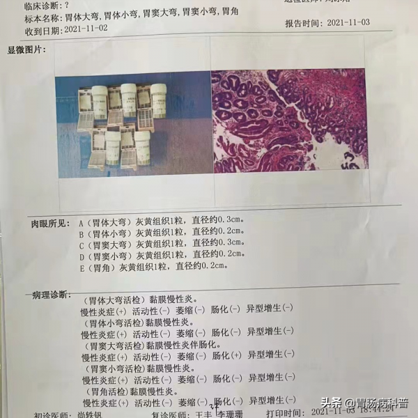 葉酸+摩羅丹,治療萎縮性胃炎伴腸化 葉酸+摩羅丹,治療萎縮性胃炎伴腸化