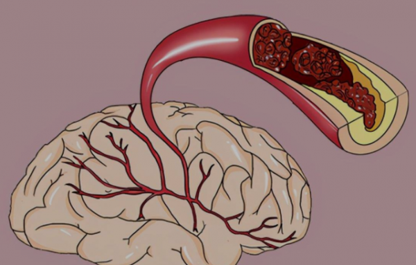 經常&OpenCurlyDoubleQuote;手麻&rdquo;的人要注意了，可能出現了4種問題，不要忽視