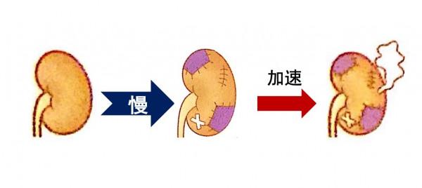什麼因素會導致慢性腎炎快速進展？「免疫相關腎臟健康科普72」