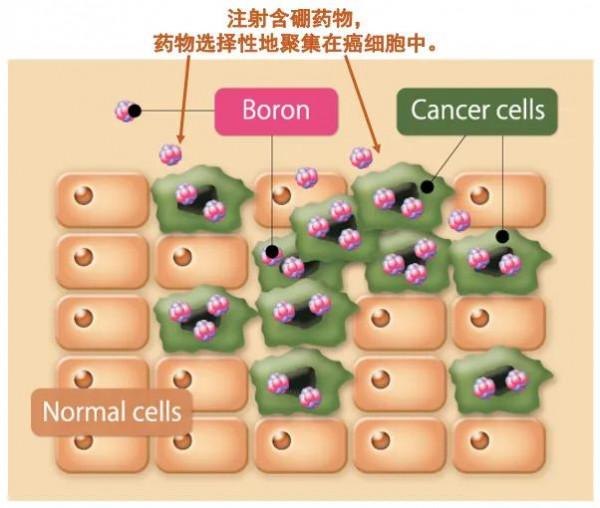 硼中子俘獲治療BNCT 硼中子俘獲治療BNCT