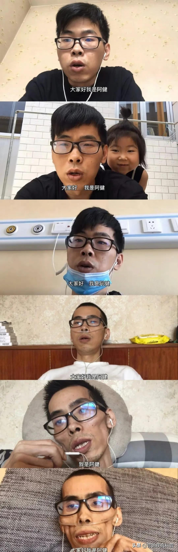 晚期腸癌到底有多可怕？34歲帥哥，患癌1年變乾瘦老人…