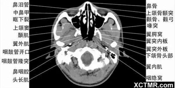 頭頸五官CT斷層解剖圖及常見病影像診斷