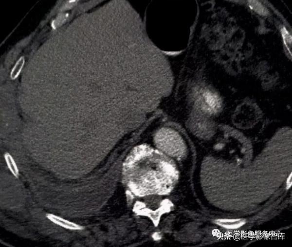 22個肺部疾病的CT徵象 22個肺部疾病的CT徵象